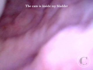 POV Endoscope Catheter Bladder Inflation - Preview