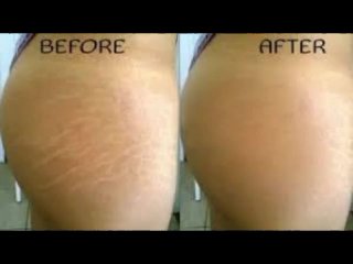 stretchmark therapy cream